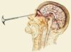 lobotomy lobotomy